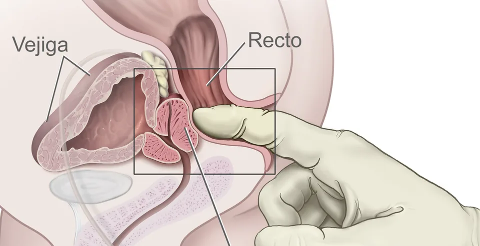Corte lateral de la pelvis masculina: un dedo con guante explora la próstata a través del recto. Se rotulan la vejiga y el recto.