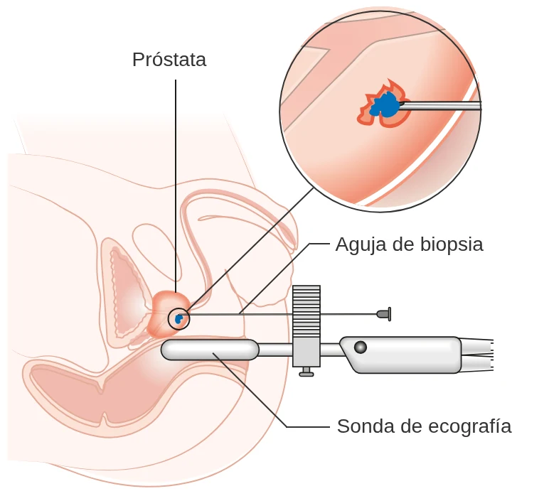 Diagrama de una biopsia transperineal: con la sonda de ecografía en el recto como guía, la aguja de biopsia entra por la piel del periné hasta la próstata.